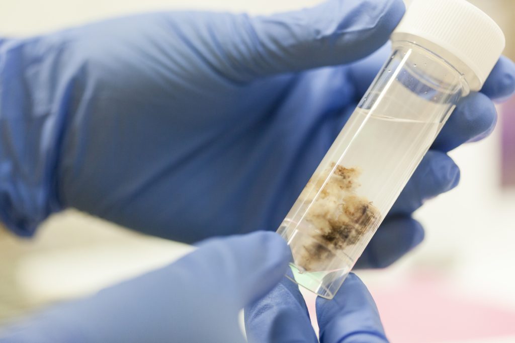 Brain Tumor Research contributing to the Barts Health neuro-oncology services designation as a Tessa Jowell Centre of Excellence