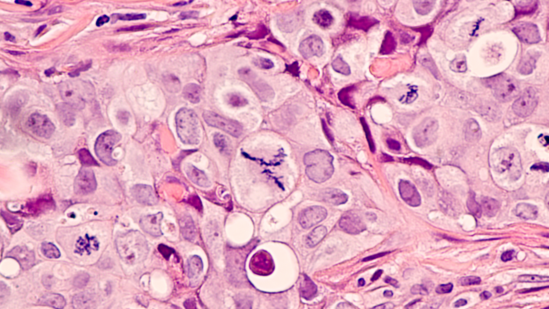 Photomicrograph of a breast cancer (grade 3 invasive ductal carcinoma) with frequent mitoses (mitotic figures), including a large central atypical mitosis.